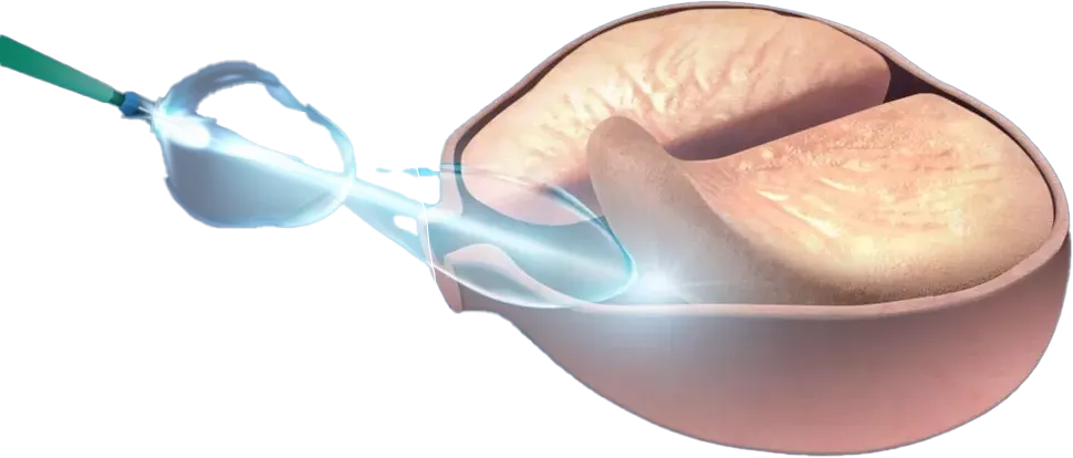 Procedimento HoLEP - Tratamento da próstata com laser